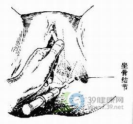 分娩_会阴侧切_顺产会阴侧切手术详解