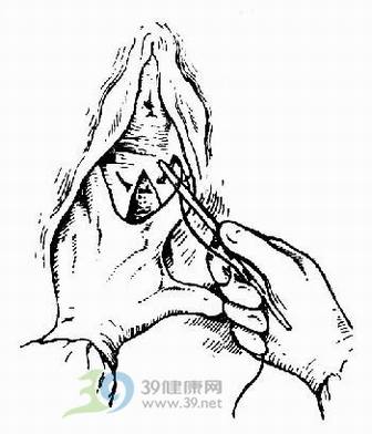 分娩_会阴侧切_顺产会阴侧切手术详解