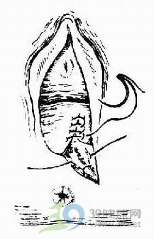 分娩_会阴侧切_顺产会阴侧切手术详解