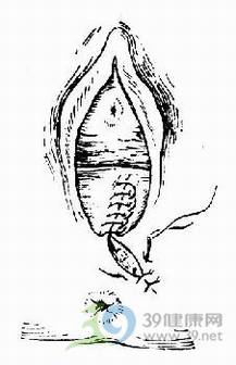 分娩_会阴侧切_顺产会阴侧切手术详解