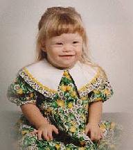 疾病常识_先天愚型