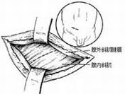 疾病常识_小儿腹股沟斜疝修复术---经腹腔疝囊高位离断术
