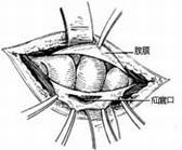 疾病常识_小儿腹股沟斜疝修复术---经腹腔疝囊高位离断术