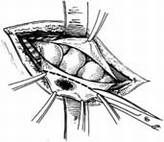 疾病常识_小儿腹股沟斜疝修复术---经腹腔疝囊高位离断术
