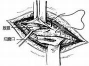 疾病常识_小儿腹股沟斜疝修复术---经腹腔疝囊高位离断术