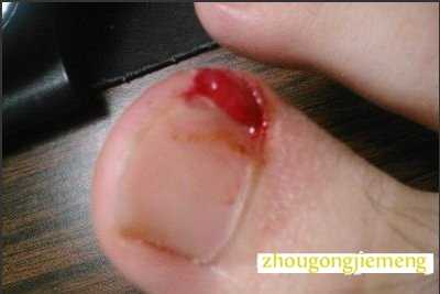 梦见脚趾出血