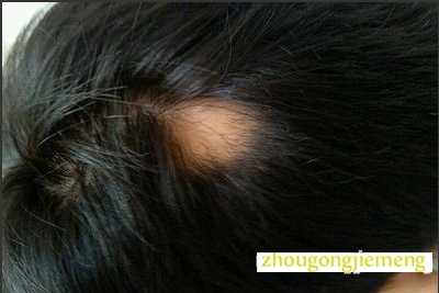 梦见掉了一缕头发