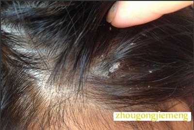 梦见掉头皮屑