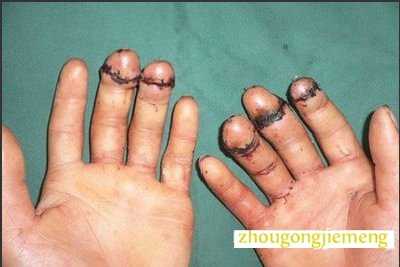 梦见手脚被切断